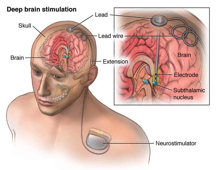 Имплант глубокой мозговой симуляции.