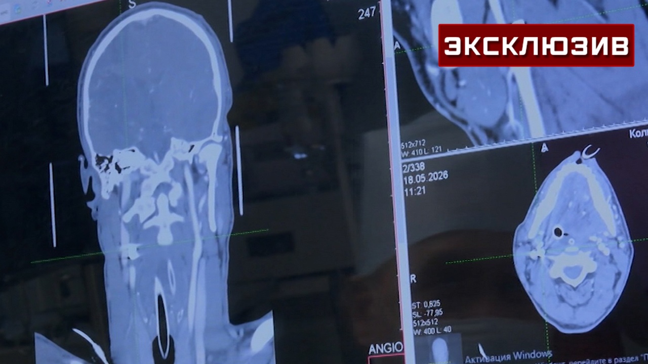 Врачи госпиталя Вишневского извлекли осколок снаряда из сонной артерии бойца